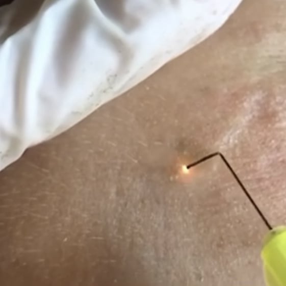 Arc Cold Plasma Behandlung